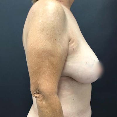 Breast Reduction Before & After Gallery - Patient 121819483 - Image 1