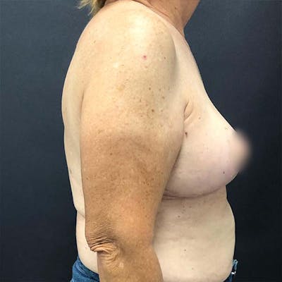 Breast Reduction Before & After Gallery - Patient 121819483 - Image 2