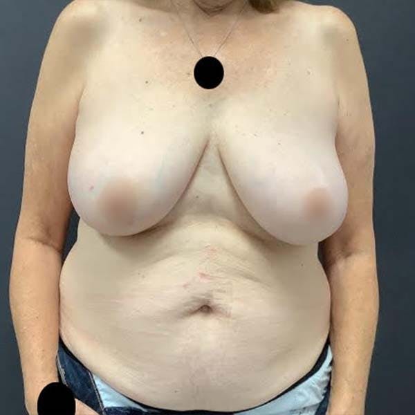 Breast Reduction Before & After Gallery - Patient 121819484 - Image 1