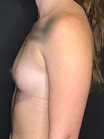 Breast Augmentation Before & After Gallery - Patient 121820029 - Image 1