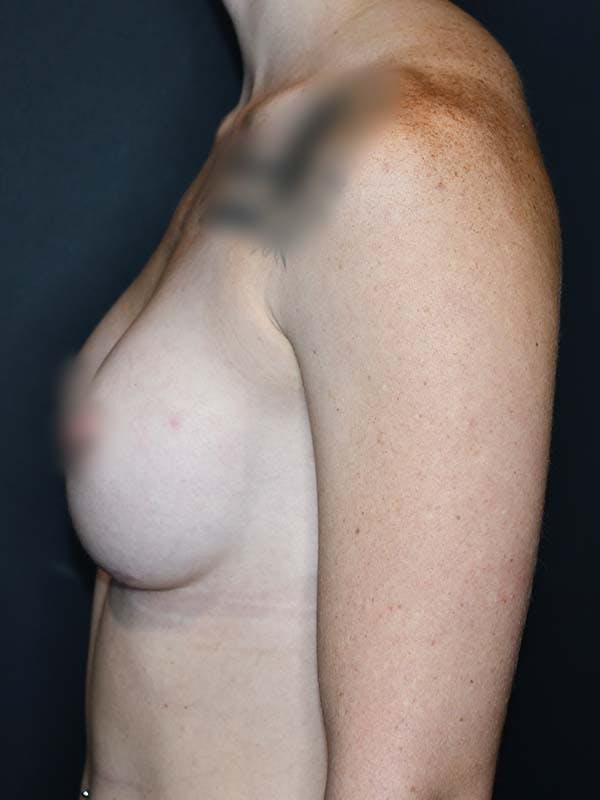 Breast Augmentation Before & After Gallery - Patient 121820029 - Image 2