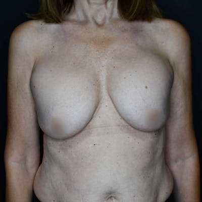 Breast Augmentation Before & After Gallery - Patient 121820031 - Image 1