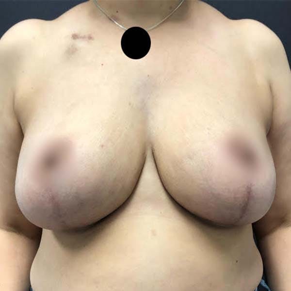 Breast Lift Before & After Gallery - Patient 121820066 - Image 2