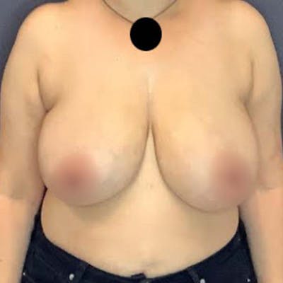 Breast Lift Before & After Gallery - Patient 121820066 - Image 1