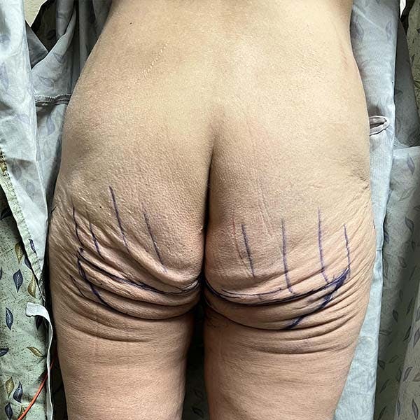 Gluteal & Thigh Lift Before & After Gallery - Patient 121820072 - Image 1