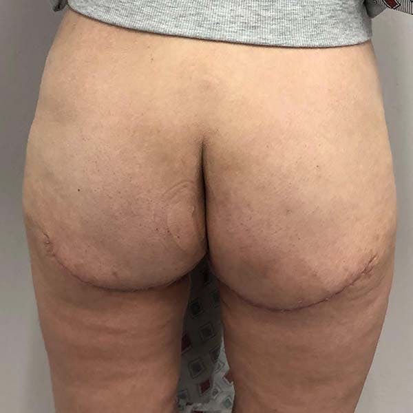 Gluteal & Thigh Lift Before & After Gallery - Patient 121820072 - Image 2