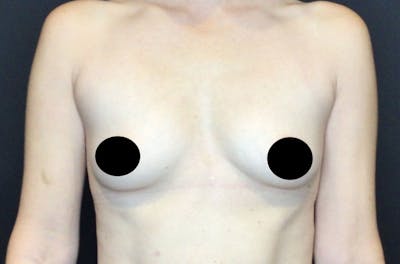 Breast Augmentation Before & After Gallery - Patient 122227629 - Image 1