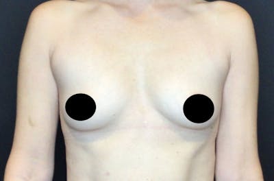 Breast Augmentation Gallery - Patient 122227629 - Image 1