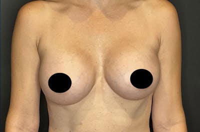 Breast Augmentation Before & After Gallery - Patient 122227629 - Image 2