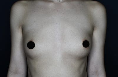 Breast Augmentation Before & After Gallery - Patient 122269913 - Image 1