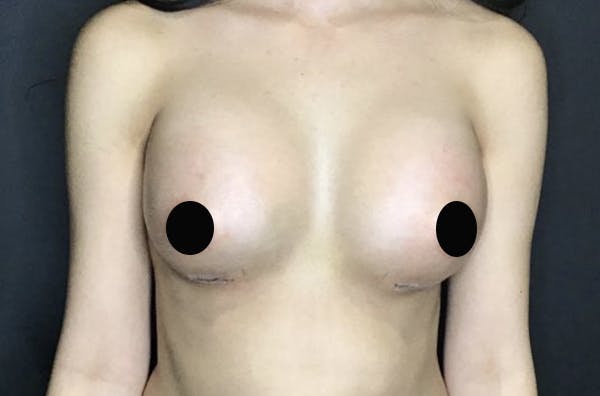 Breast Augmentation Before & After Gallery - Patient 122269913 - Image 2
