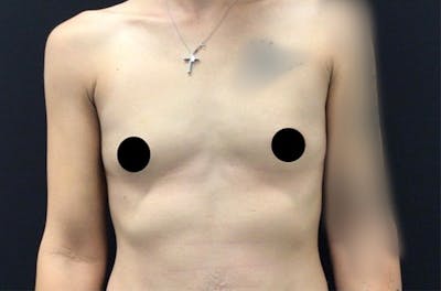 Breast Augmentation Before & After Gallery - Patient 122404913 - Image 1