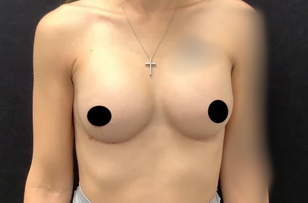 Breast Augmentation Before & After Gallery - Patient 122404913 - Image 2
