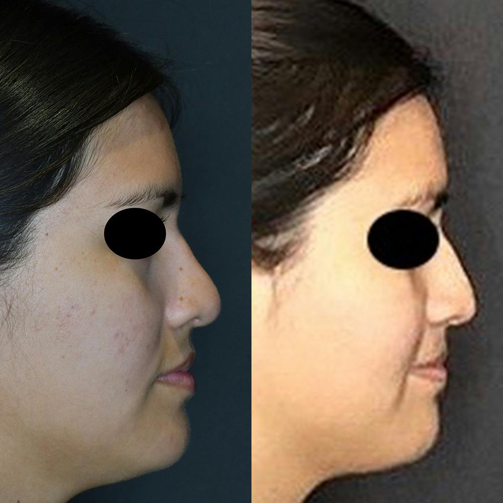 Rhinoplasty Before & After Gallery - Patient 122597234 - Image 1
