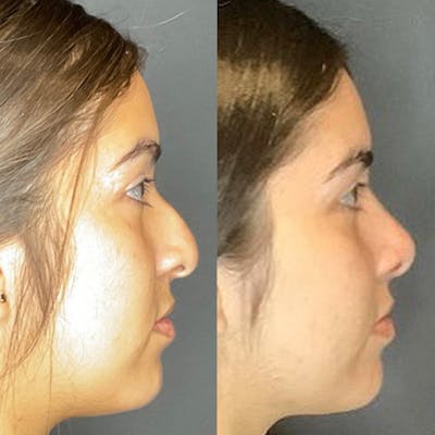 Rhinoplasty Before & After Gallery - Patient 122597257 - Image 1