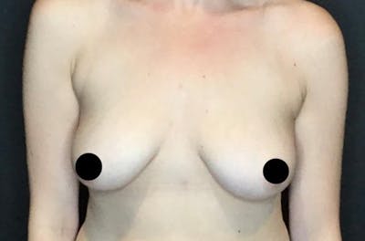 Breast Augmentation Before & After Gallery - Patient 122597352 - Image 1