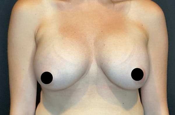 Breast Augmentation Before & After Gallery - Patient 122597352 - Image 2
