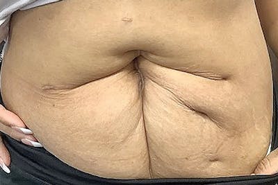 Tummy Tuck (Abdominoplasty) Before & After Gallery - Patient 122852251 - Image 1