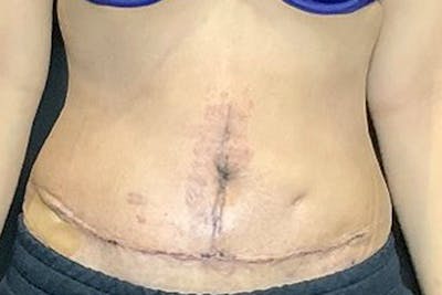 Tummy Tuck (Abdominoplasty) Before & After Gallery - Patient 122852251 - Image 2