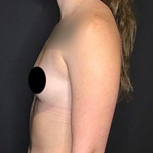 Breast Augmentation Before & After Gallery - Patient 121820040 - Image 5
