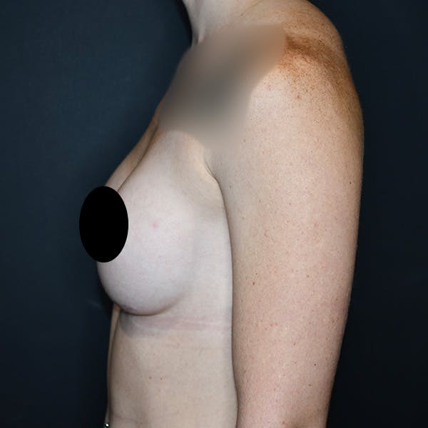 Breast Augmentation Before & After Gallery - Patient 121820040 - Image 6
