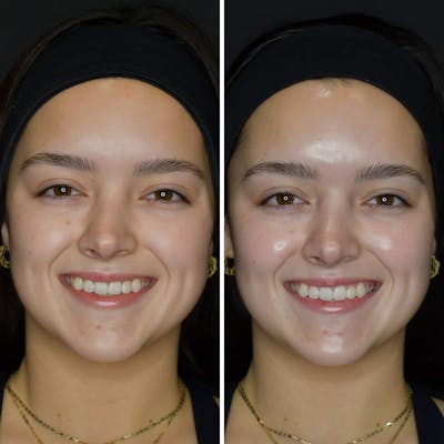 Hydrafacial Before & After Gallery - Patient 144406105 - Image 1