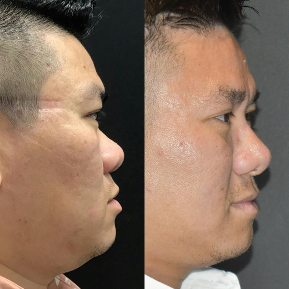Rhinoplasty Before & After Gallery - Patient 144486639 - Image 1