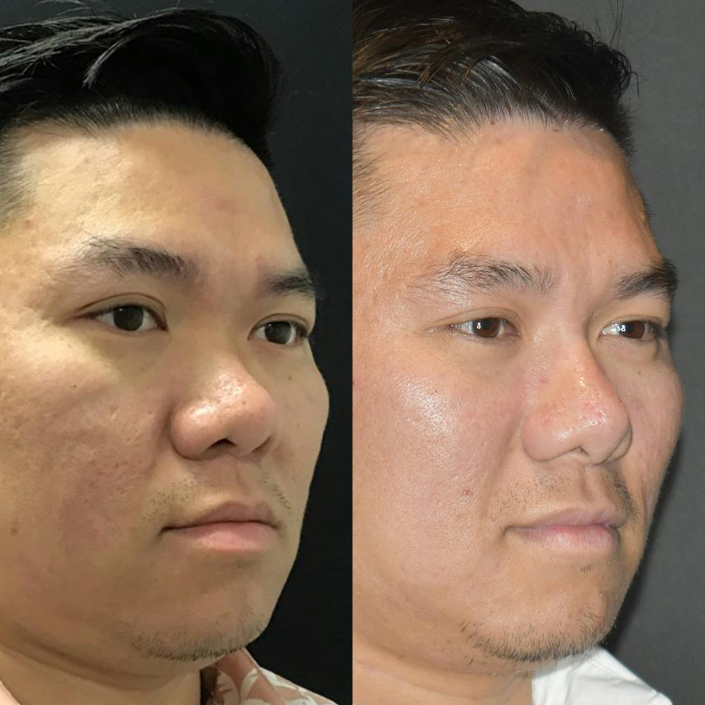 Rhinoplasty Before & After Gallery - Patient 144486639 - Image 2