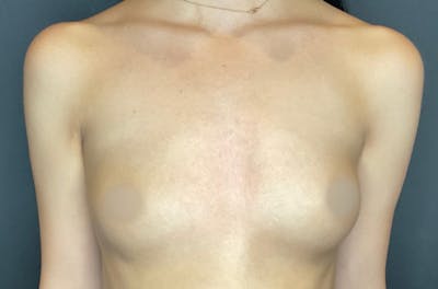 Breast Augmentation Before & After Gallery - Patient 144486640 - Image 1