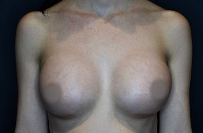 Breast Augmentation Before & After Gallery - Patient 144486640 - Image 2