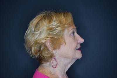 Facelift Before & After Gallery - Patient 144976631 - Image 1