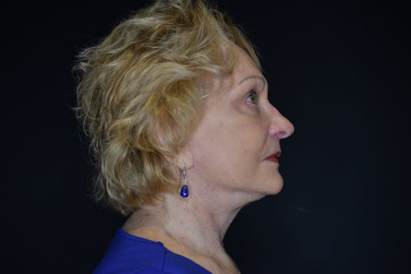 Neck Lift Before & After Gallery - Patient 148099878 - Image 2