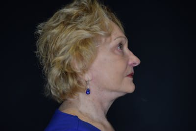 Neck Lift Before & After Gallery - Patient 148099878 - Image 2
