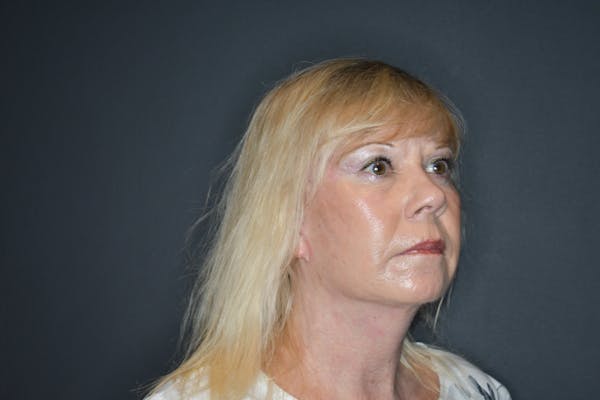 Facelift Before & After Gallery - Patient 145104822 - Image 2