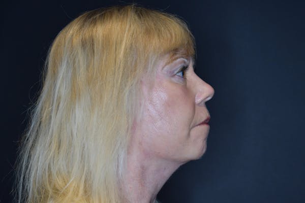 Facelift Before & After Gallery - Patient 145104822 - Image 4
