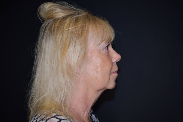 Facelift Before & After Gallery - Patient 145104822 - Image 3