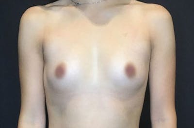 Breast Augmentation Before & After Gallery - Patient 146691978 - Image 1