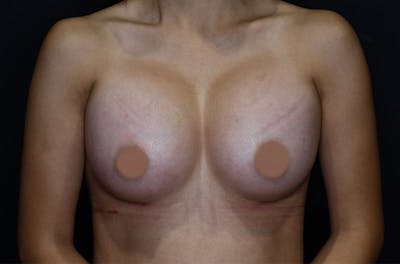 Breast Augmentation Before & After Gallery - Patient 146691978 - Image 2