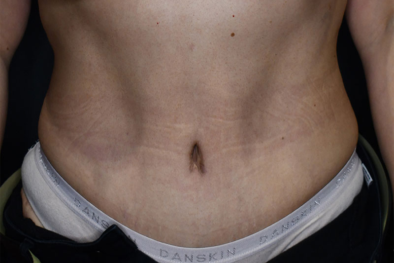 Tummy Tuck Phoenix  Abdominoplasty in Surprise