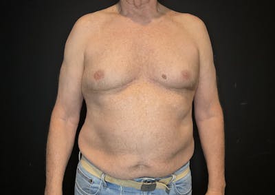 Liposuction Before & After Gallery - Patient 147124340 - Image 1