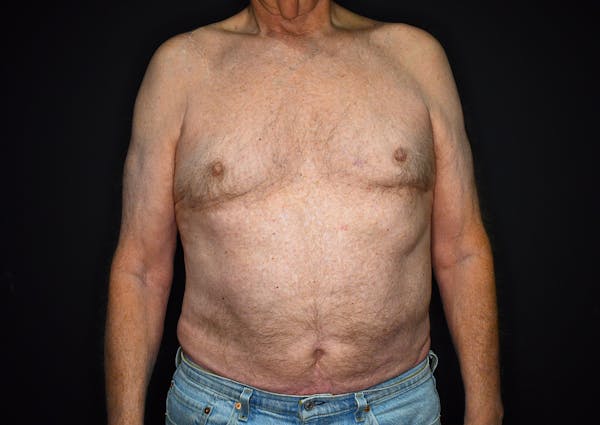 Liposuction Before & After Gallery - Patient 147124340 - Image 2