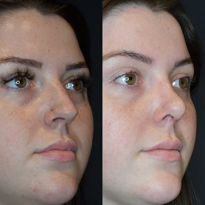 Rhinoplasty Before & After Gallery - Patient 147124342 - Image 1
