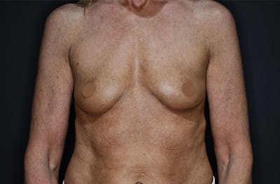 Breast Augmentation Before & After Gallery - Patient 147741274 - Image 1