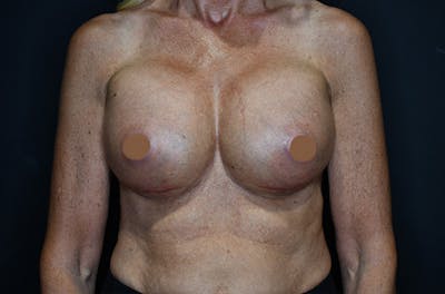 Breast Augmentation Before & After Gallery - Patient 147741274 - Image 2