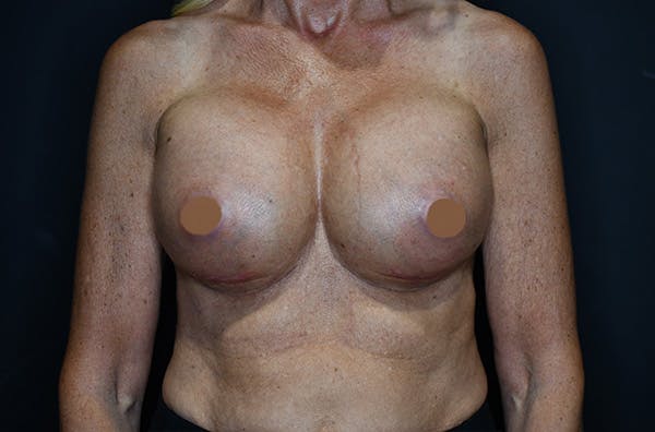 Breast Augmentation Before & After Gallery - Patient 147741274 - Image 2