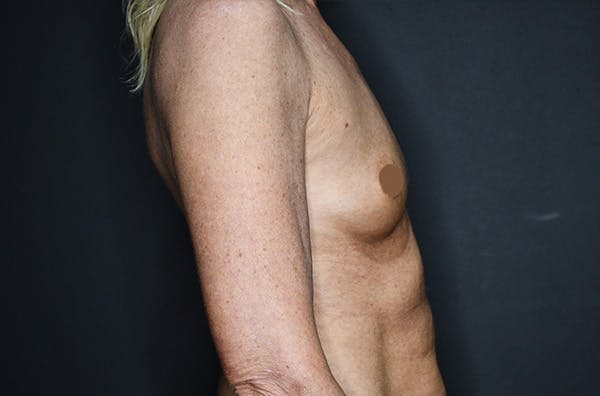 Breast Augmentation Before & After Gallery - Patient 147741274 - Image 3