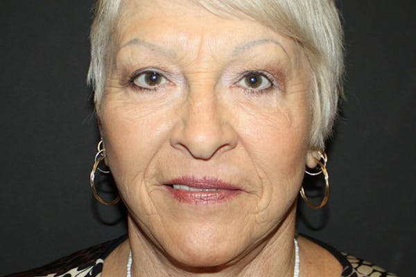 Facelift Before & After Gallery - Patient 5794649 - Image 2