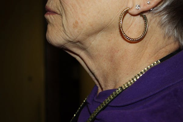Neck Lift Before & After Gallery - Patient 148099876 - Image 1