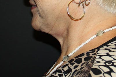 Neck Lift Before & After Gallery - Patient 148099876 - Image 2