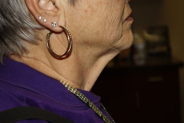 Neck Lift Before & After Gallery - Patient 148099876 - Image 3